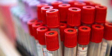Obniżenie cholesterolu to tysiące mniej zawałów i udarów-28173